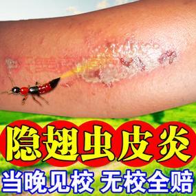 被隐翅虫咬了怎么办？隐翅虫百科教你紧急处理！