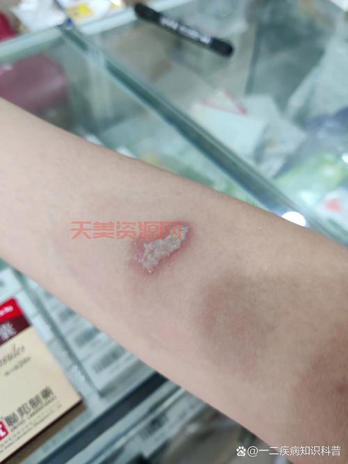被隐翅虫咬了怎么办？隐翅虫百科教你紧急处理！