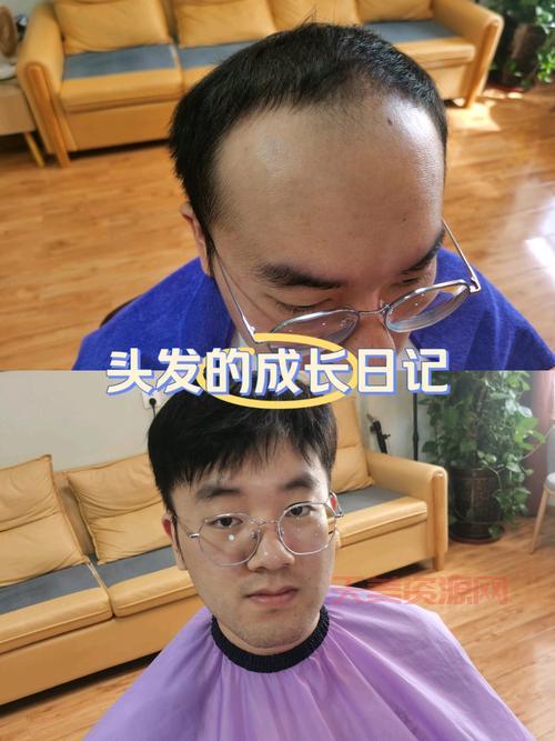 男生秃鬓角怎么办？教你几招轻松搞定！