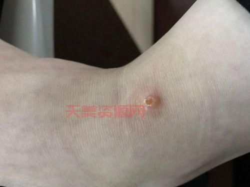 纺织娘会咬人吗？被咬了应该怎么处理呢？